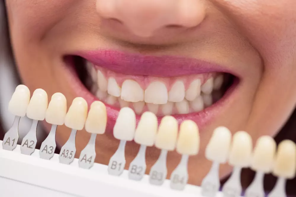 tipos de blanqueamiento dental