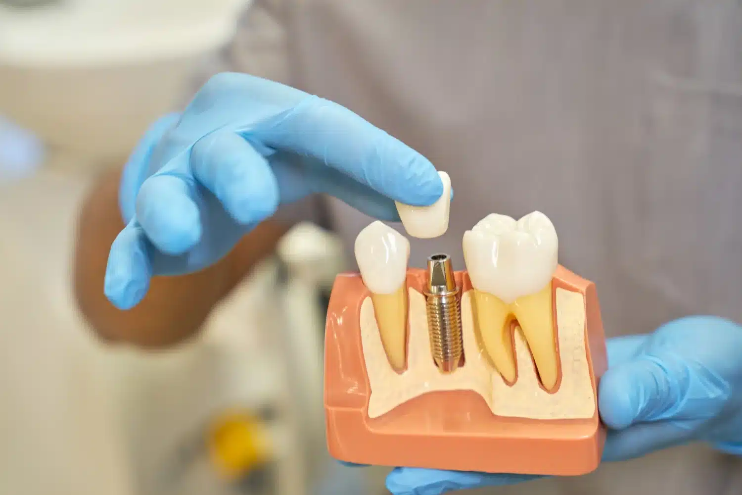 En qué consisten los implantes dentales